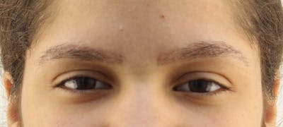 Eyebrow Transplant Before & After Gallery - Patient 122877800 - Image 2