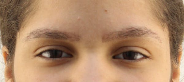 Eyebrow Transplant Before & After Gallery - Patient 122877800 - Image 2