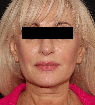 Facelift Before & After Gallery - Patient 122947627 - Image 1