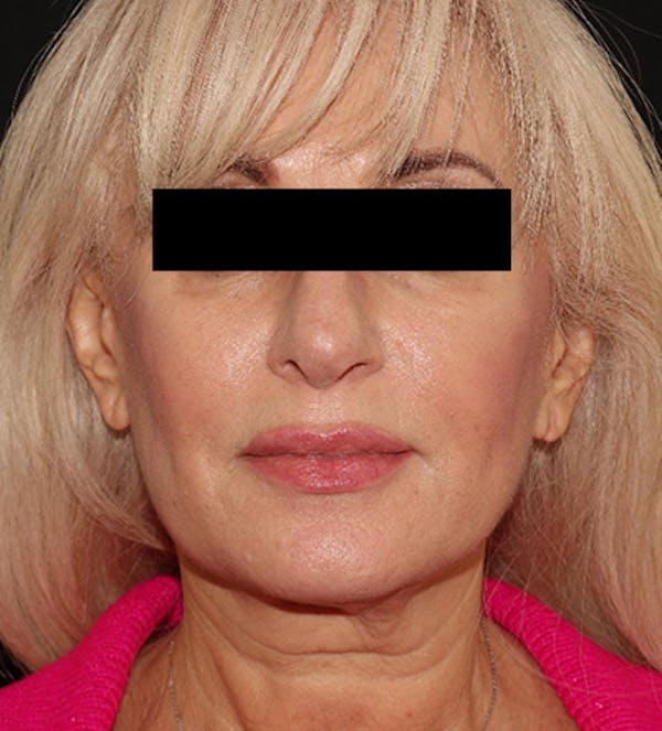 Facelift Before & After Gallery - Patient 122947627 - Image 1