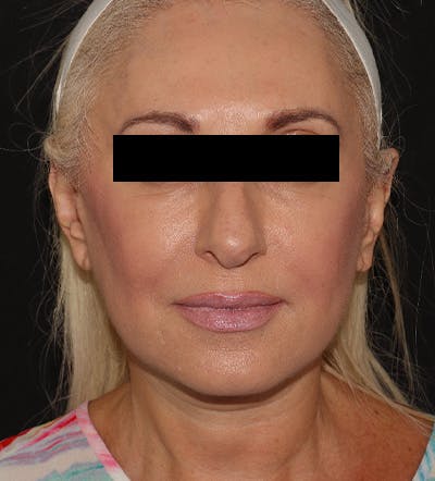 Facelift Before & After Gallery - Patient 122947627 - Image 2