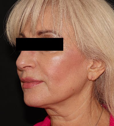 Facelift Before & After Gallery - Patient 122947627 - Image 3
