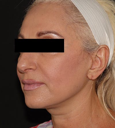 Facelift Before & After Gallery - Patient 122947627 - Image 4