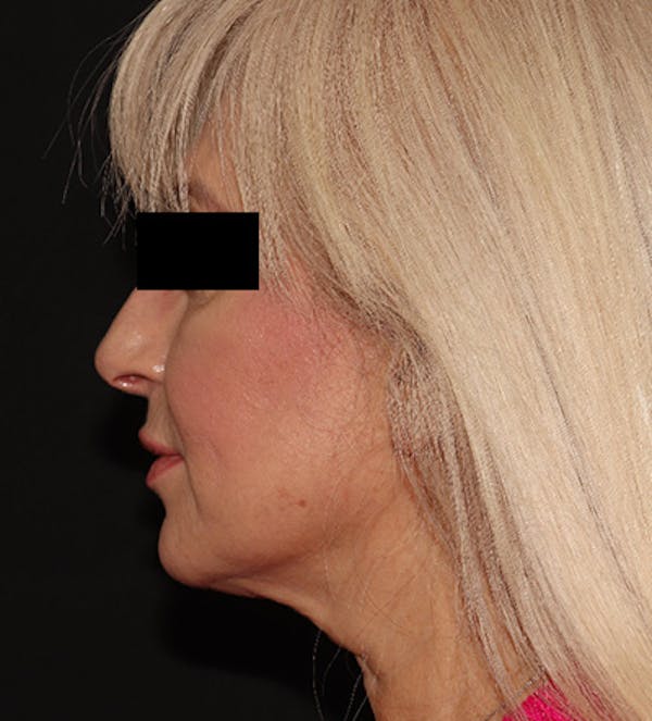 Facelift Before & After Gallery - Patient 122947627 - Image 5