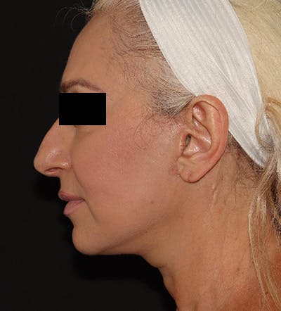 Facelift Before & After Gallery - Patient 122947627 - Image 6
