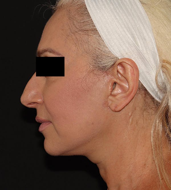 Facelift Before & After Gallery - Patient 122947627 - Image 6