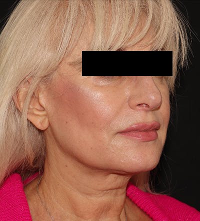 Facelift Before & After Gallery - Patient 122947627 - Image 7