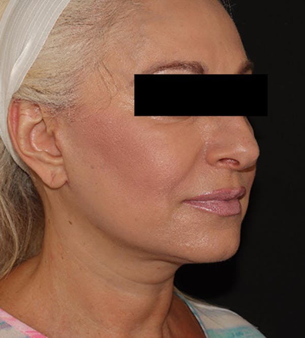 Facelift Before & After Gallery - Patient 122947627 - Image 8