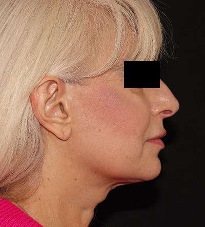 Facelift Before & After Gallery - Patient 122947627 - Image 9