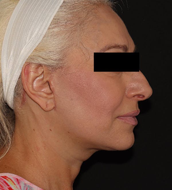Facelift Before & After Gallery - Patient 122947627 - Image 10