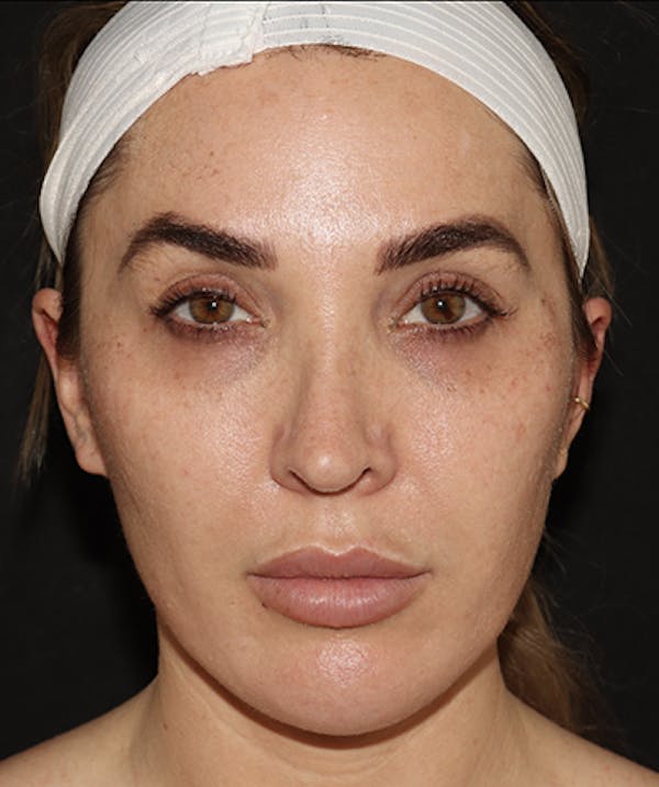  Blepharoplasty Before & After Gallery - Patient 123043566 - Image 1