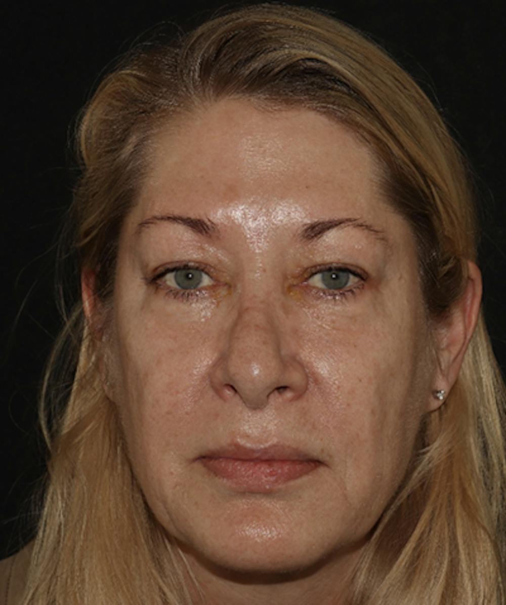  Blepharoplasty Before & After Gallery - Patient 123043565 - Image 1
