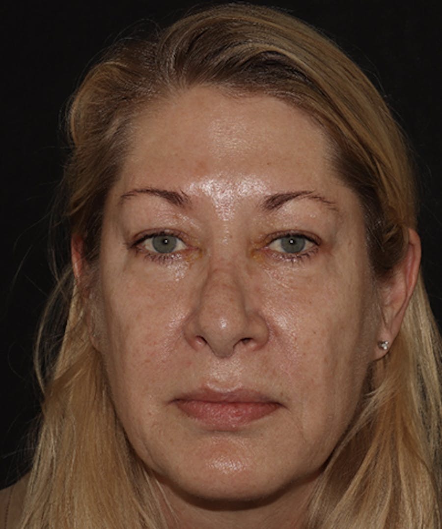  Blepharoplasty Before & After Gallery - Patient 123043565 - Image 1