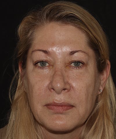 Before and After Blepharoplasty in NYC 01