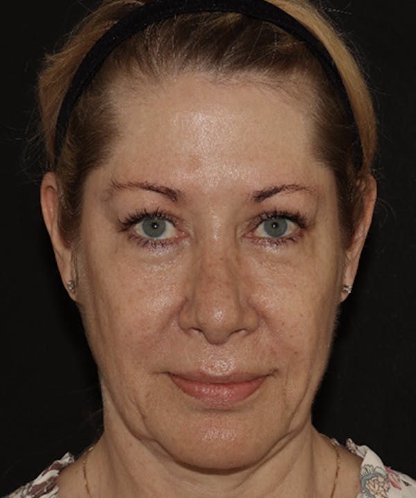 Before and After Blepharoplasty in NYC 01