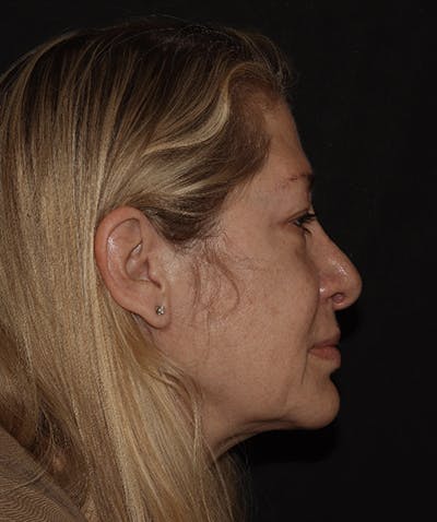 Rhinoplasty Before & After Gallery - Patient 123044001 - Image 3