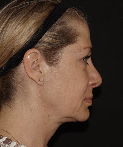  Blepharoplasty Before & After Gallery - Patient 123043565 - Image 4