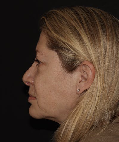 Rhinoplasty Before & After Gallery - Patient 123044001 - Image 5