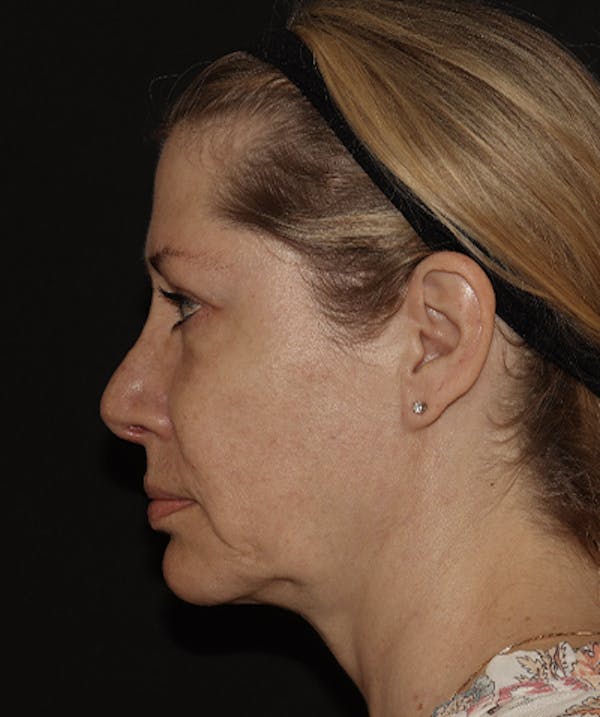  Blepharoplasty Before & After Gallery - Patient 123043565 - Image 6