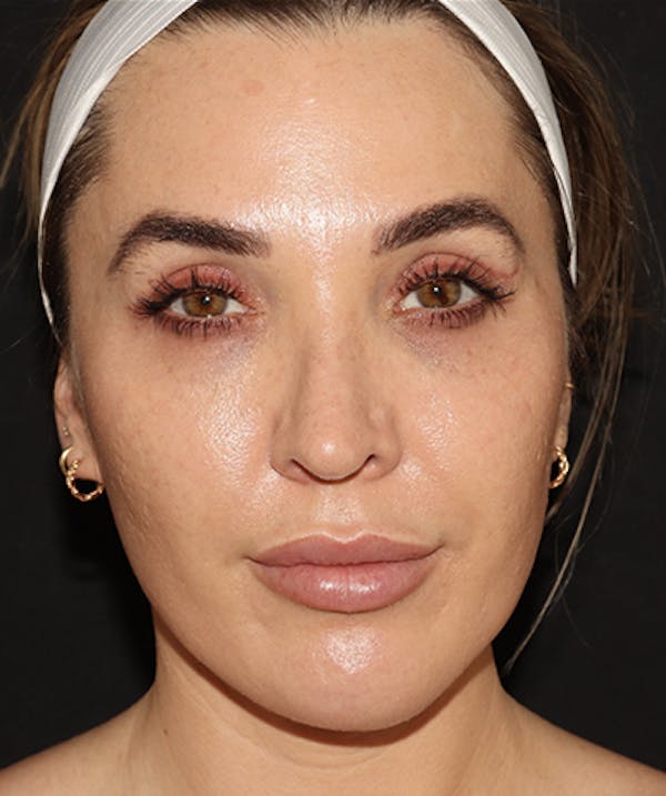 Before and After Eyelid Surgery in Westchester 02