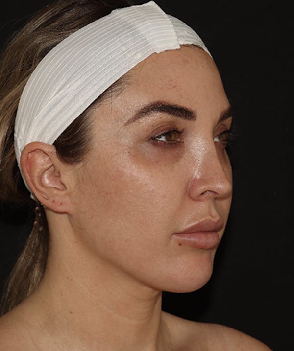  Blepharoplasty Before & After Gallery - Patient 123043566 - Image 3