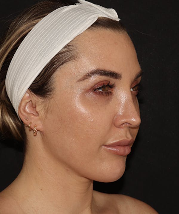  Blepharoplasty Before & After Gallery - Patient 123043566 - Image 4