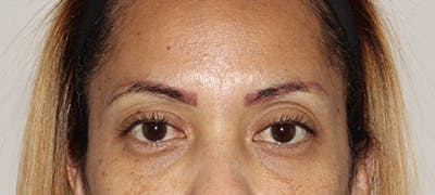 Eyebrow Transplant Before & After Gallery - Patient 123043664 - Image 1