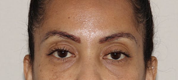 Eyebrow Transplant Before & After Gallery - Patient 123043664 - Image 2