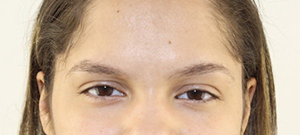 Eyebrow Transplant Before & After Gallery - Patient 123043665 - Image 1