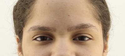 Eyebrow Transplant Before & After Gallery - Patient 123043665 - Image 2