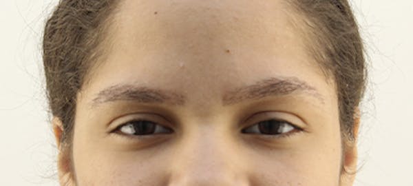 Eyebrow Transplant Before & After Gallery - Patient 123043665 - Image 2