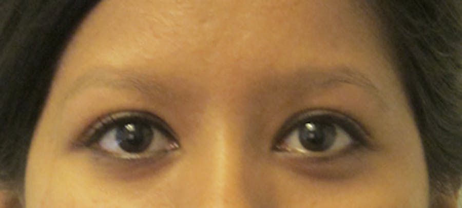 Eyebrow Transplant Before & After Gallery - Patient 123043666 - Image 1