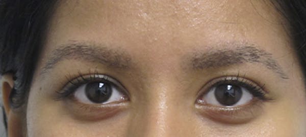 Eyebrow Transplant Before & After Gallery - Patient 123043666 - Image 2