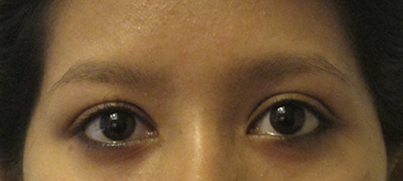 Eyebrow Transplant Before & After Gallery - Patient 123043667 - Image 1