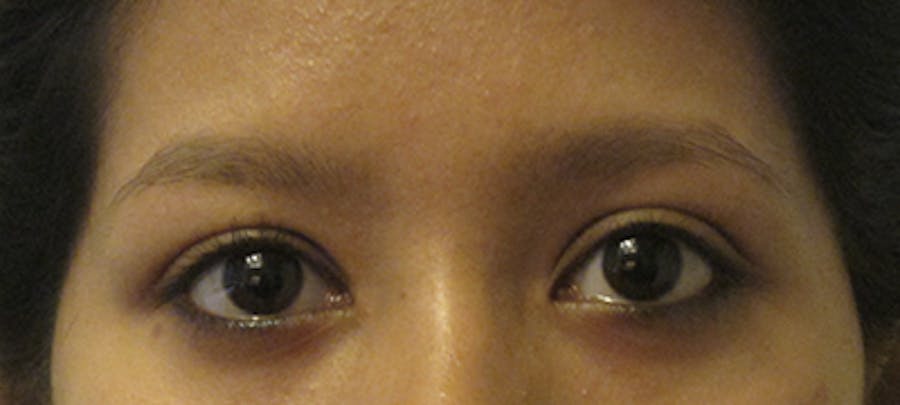 Eyebrow Transplant Before & After Gallery - Patient 123043667 - Image 1