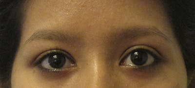 Eyebrow Transplant Before & After Gallery - Patient 123043667 - Image 1