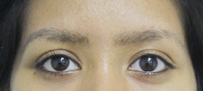 Eyebrow Transplant Before & After Gallery - Patient 123043667 - Image 2