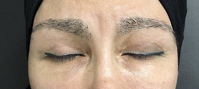 Eyebrow Transplant Before & After Gallery - Patient 123043668 - Image 1
