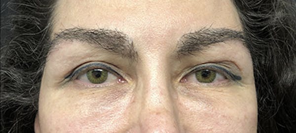 Eyebrow Transplant Before & After Gallery - Patient 123043668 - Image 2