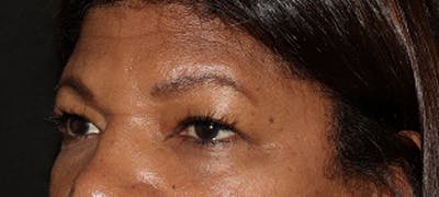 Eyebrow Transplant Before & After Gallery - Patient 123043669 - Image 1