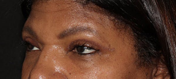Eyebrow Transplant Before & After Gallery - Patient 123043669 - Image 2