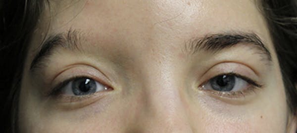 Eyebrow Transplant Before & After Gallery - Patient 123043670 - Image 1