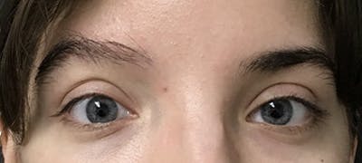 Eyebrow Transplant Before & After Gallery - Patient 123043670 - Image 2