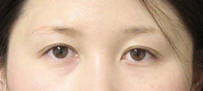 Eyebrow Transplant Before & After Gallery - Patient 123043671 - Image 1