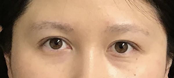 Eyebrow Transplant Before & After Gallery - Patient 123043671 - Image 2