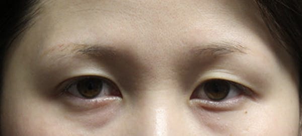 Eyebrow Transplant Before & After Gallery - Patient 123043672 - Image 1