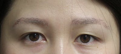 Eyebrow Transplant Before & After Gallery - Patient 123043672 - Image 2