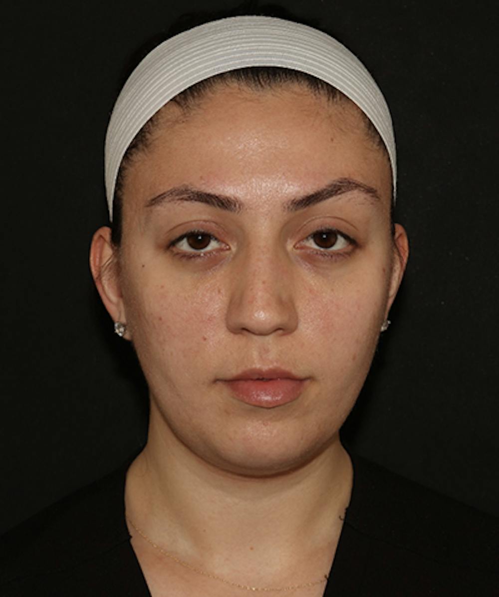 Facial Fat Grafting Before & After Gallery - Patient 169737561 - Image 1