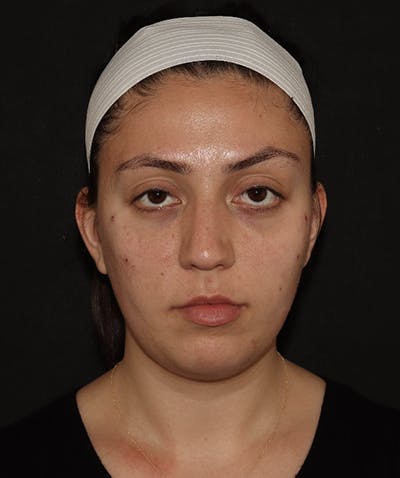 Facial Fat Grafting Before & After Gallery - Patient 169737561 - Image 2