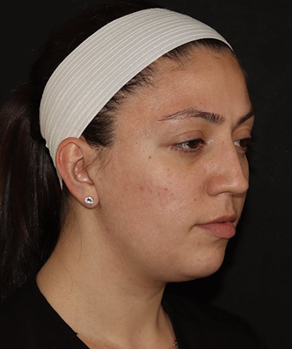 Facial Fat Grafting Before & After Gallery - Patient 169737561 - Image 3